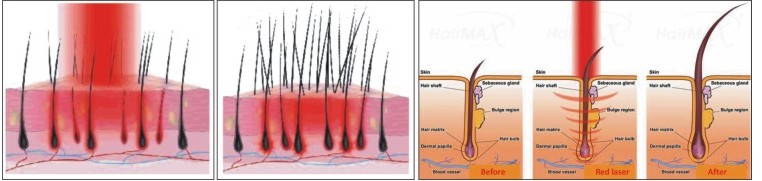 Laser Hair Regrowth Machine